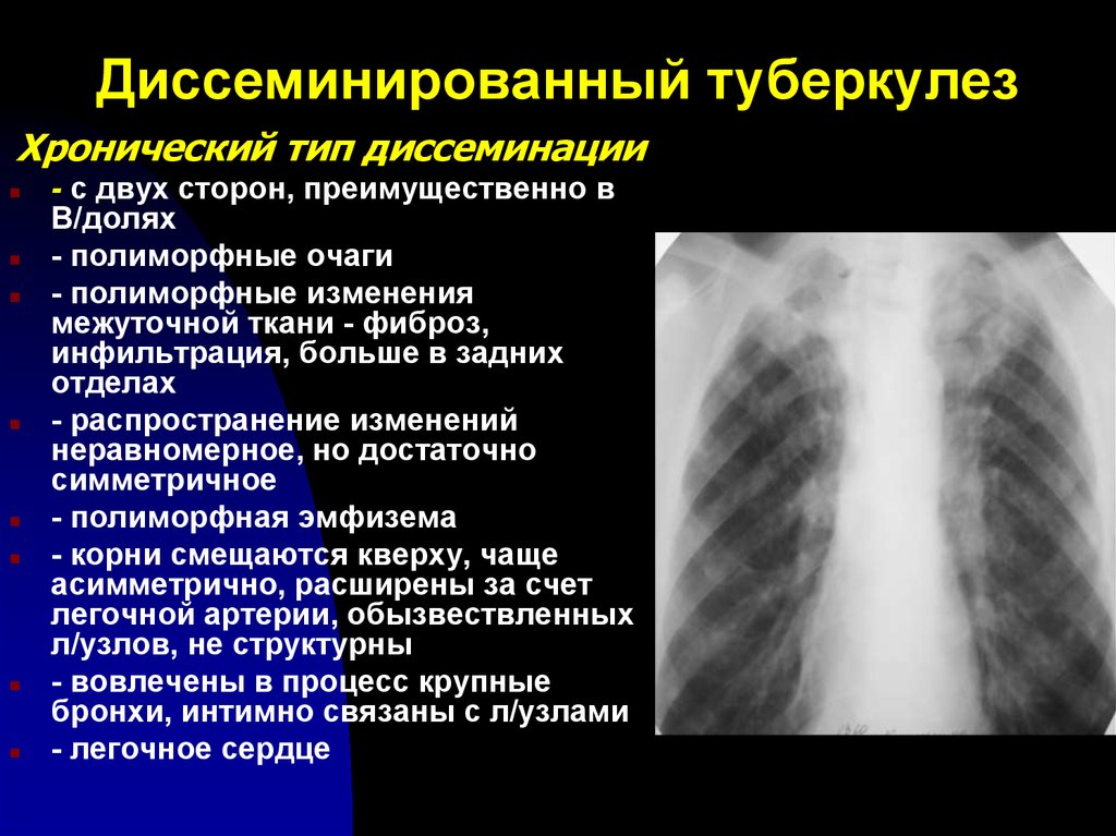 Формы диссеминированного туберкулеза. Лимфогенно диссеминированный туберкулез рентген. Хронический диссеминированный туберкулез рентген. Диссеминированный туберкулез рентген. Подострый диссеминированный туберкулез рентген.