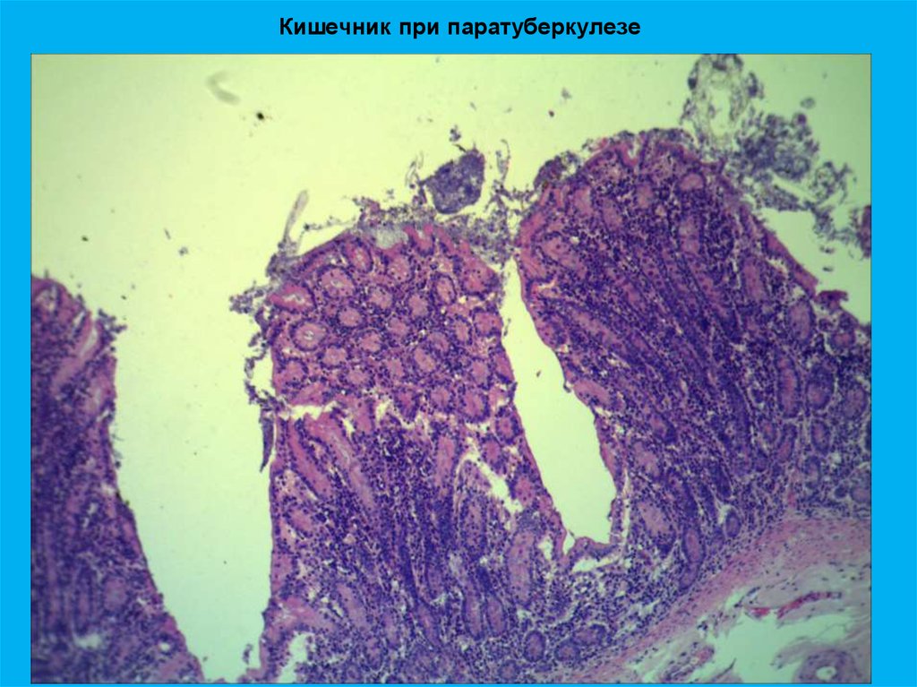 Туберкулез кишечника картинки