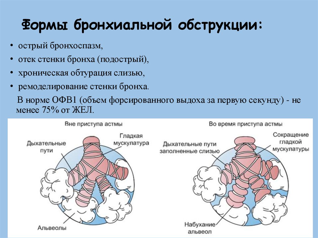 Бронхиальная обструкция