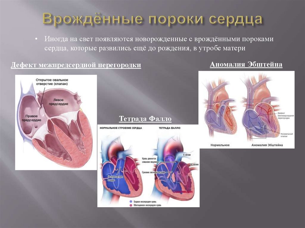 Порог сердца что это. Врожденный порок сердца (ВПС). 3 Тип порока сердца у плода. Вражденный порог серца. Врожденный порог сердца.