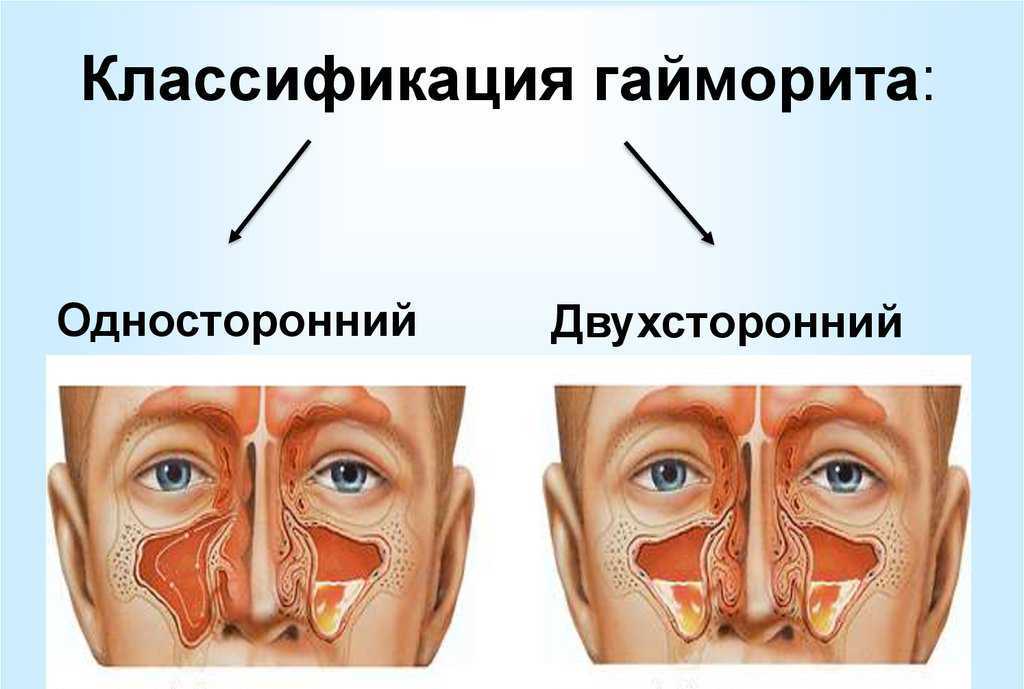 Презентация гайморит лечение