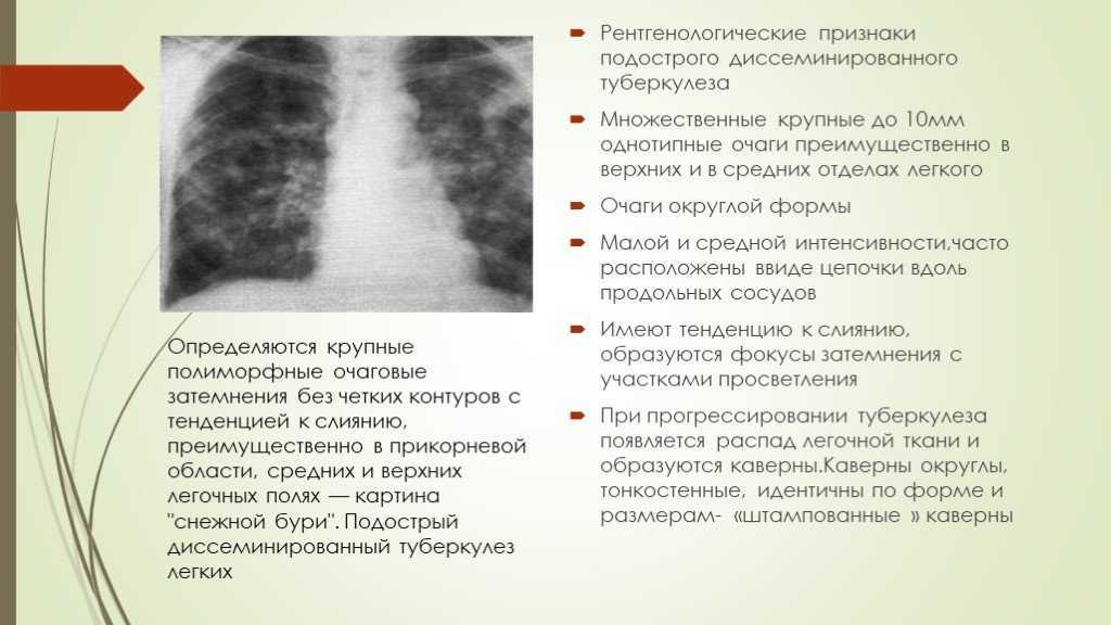 Что означает изменения в легких. Рентген признаки диссеминированного туберкулеза легких. Рентгенологические признаки диссеминированного туберкулеза. Диссеминированный туберкулез легких рентген. Подострый диссеминированный туберкулез легких диагностика.