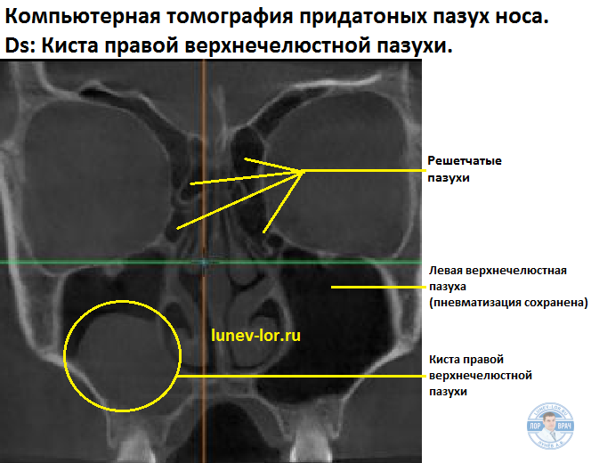 Состояние вчп. Киста гайморовой пазухи на кт. Киста верхнечелюстной пазухи на кт. Рентген околоносовых пазух киста. Киста верхнечелюстной пазухи СКТ.