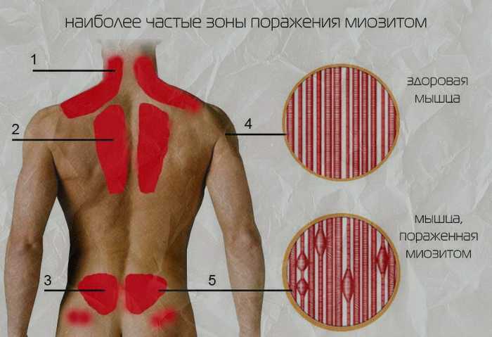 Болят лопатки и верх спины. Болит спина сзади. Продуло спину. Болит сзади сверху спины. Продуло поясницу.