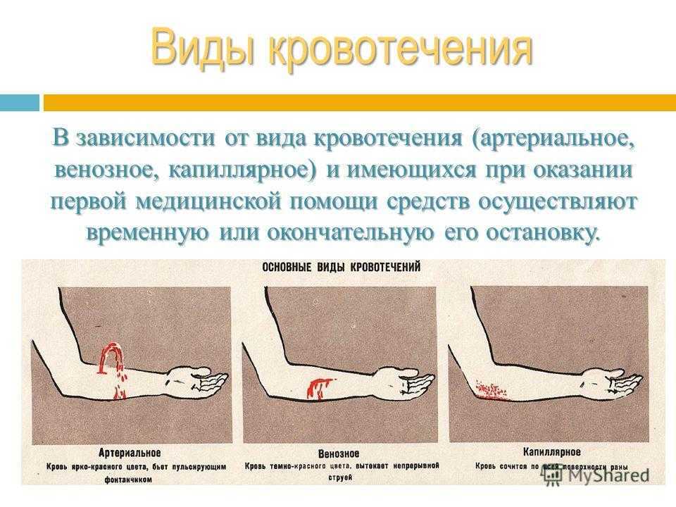 Правила остановки артериального кровотечения обж 11 класс презентация