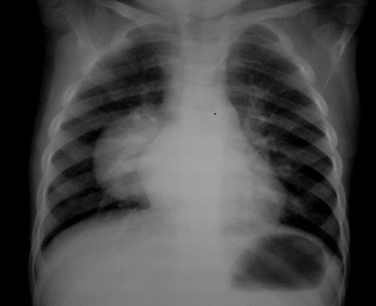 Туберкулез легкого рентгенограмма. Рентген грудной клетки туберкулез. Рентгенограмма грудной клетки туберкулез. Легкие туберкулезника рентген.