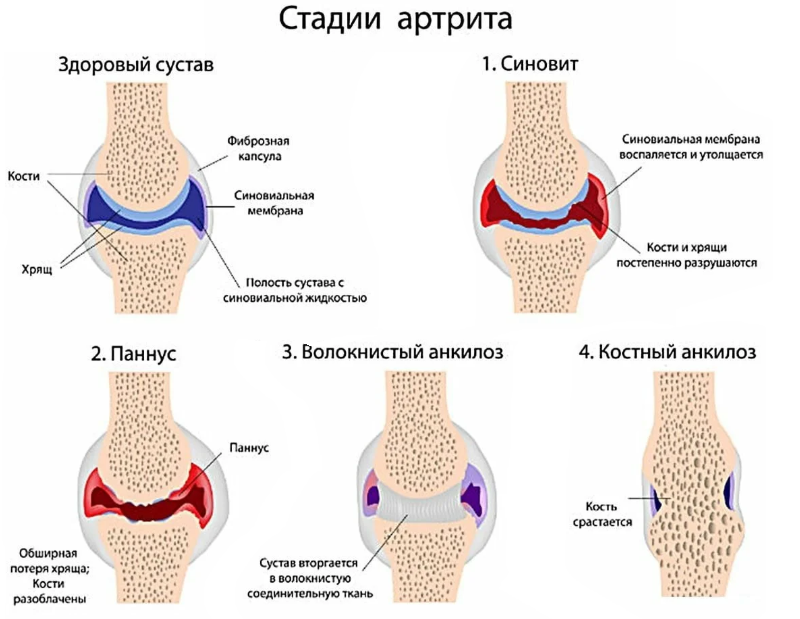 Болят суставы причины. Степени ревматоидного артрита. Стадии ревматоидного остеоартрита. Ревматоидный артрит 1 стадия. Стадии ревматоидного артрита паннус.