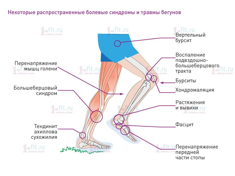 Тэп сустава. Синдром илиотибиального тракта. Ноет нога ниже колена сбоку с внешней стороны. Подвздошно большеберцовый тракт. Болит колено после бега с внутренней стороны сбоку.