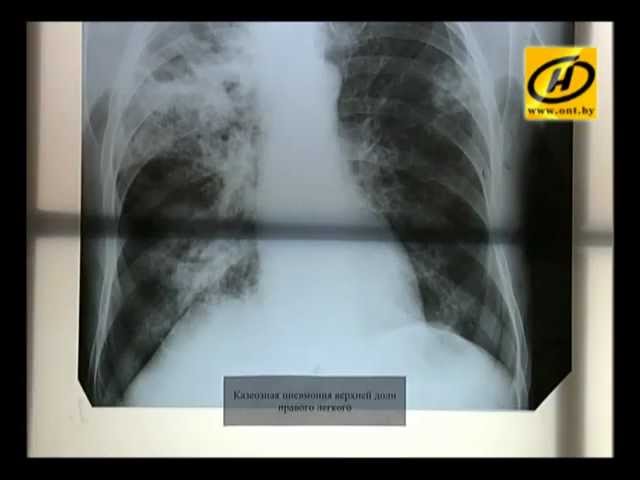 Маммографию после флюорографии. Снимок флюорографии курильщика. Лёгкие курящего человека на флюорографии. Флюорография грудной клетки курильщика.