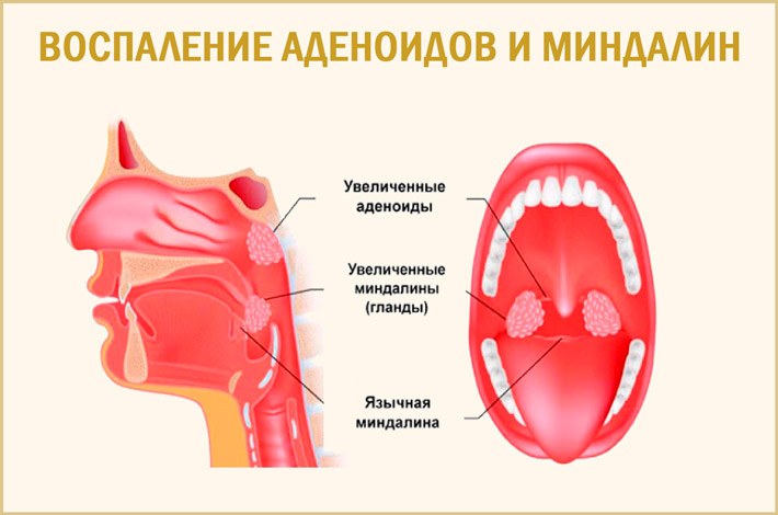 Где находятся аденоиды у ребенка картинка