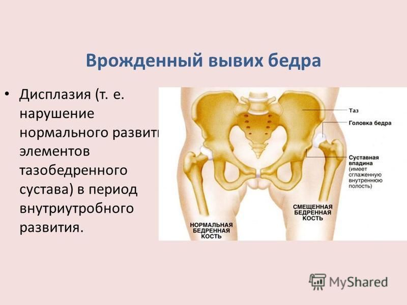 Вывих и подвывих схема