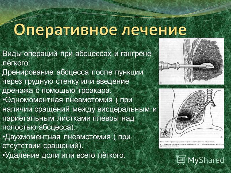 Абсцесс легкого операция