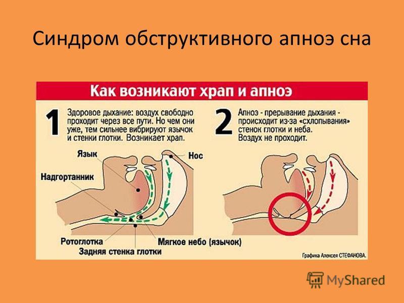 Останавливается дыхание во сне причины. Синдром обструктивного апноэ. Синдром обструктивного апноэ сна. СОАС синдром обструктивного апноэ сна. Синдром остановки дыхания.