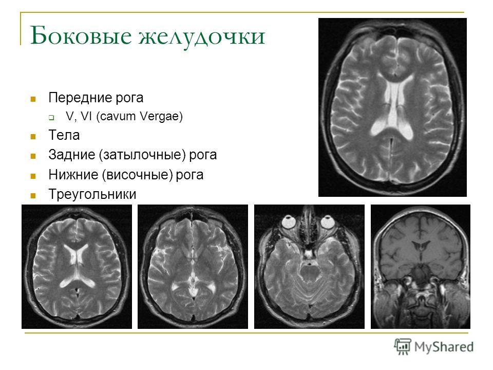 Расширение желудочков. Боковые желудочки мозга рога на кт. Передний Рог бокового желудочка. Задние боковые желудочки головного мозга. Задние рога боковых желудочков мозга.