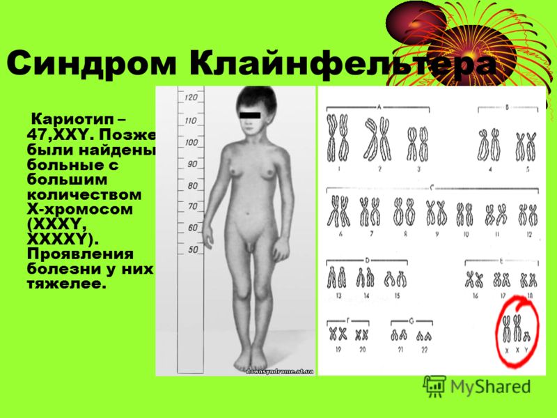 Хромосомы мальчика. Хромосомные болезни синдром Клайнфельтера. Синдром Клайнфельтера 47 xxy. Синдром Клайнфельтера анеуплоидия. Xxy синдром Клайнфельтера.