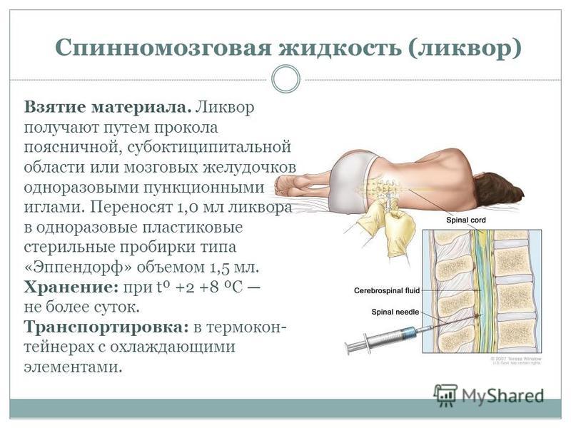 Люмбальная пункция мозга