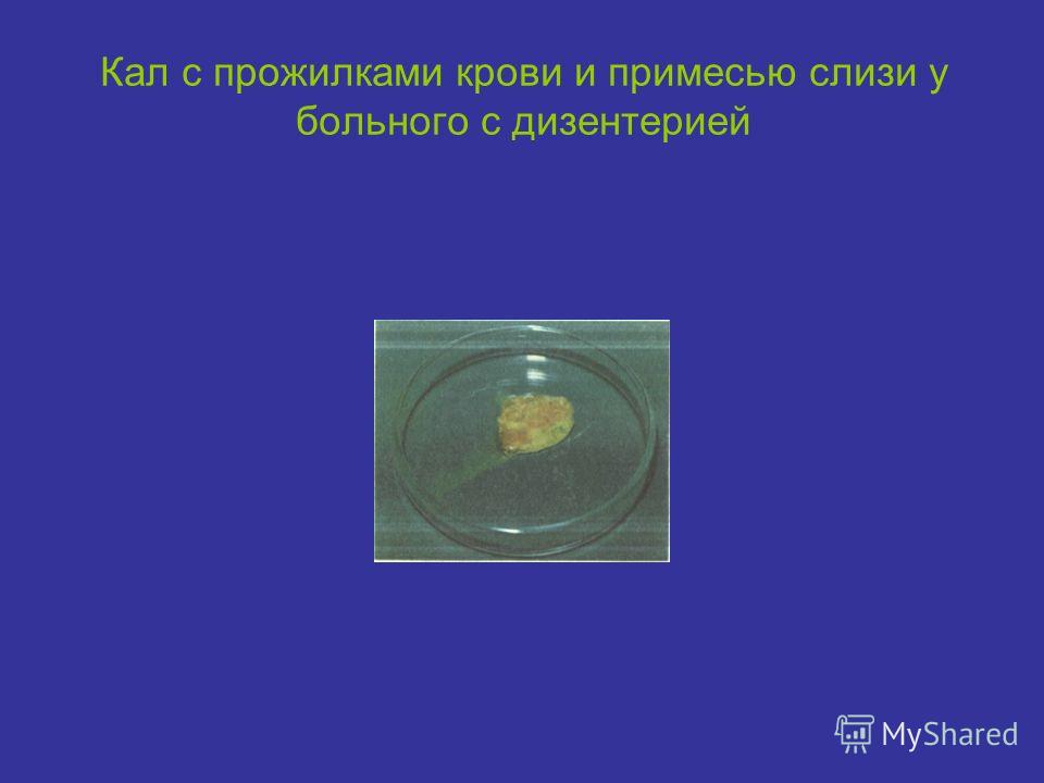 Стул в виде ректального плевка характерен для