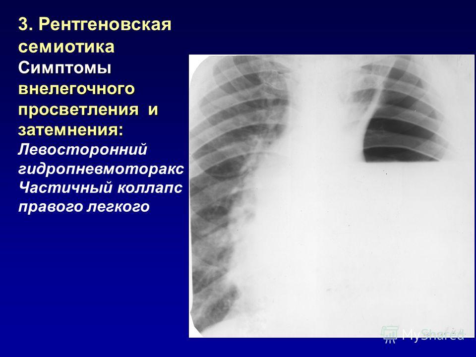 Рентгена 3. Пневмогидроторакс рентген. Левосторонний гидропневмоторакс. Пневмогидроторакс рентгенограмма описание. Гидропневмоторакс описание рентгенограммы.