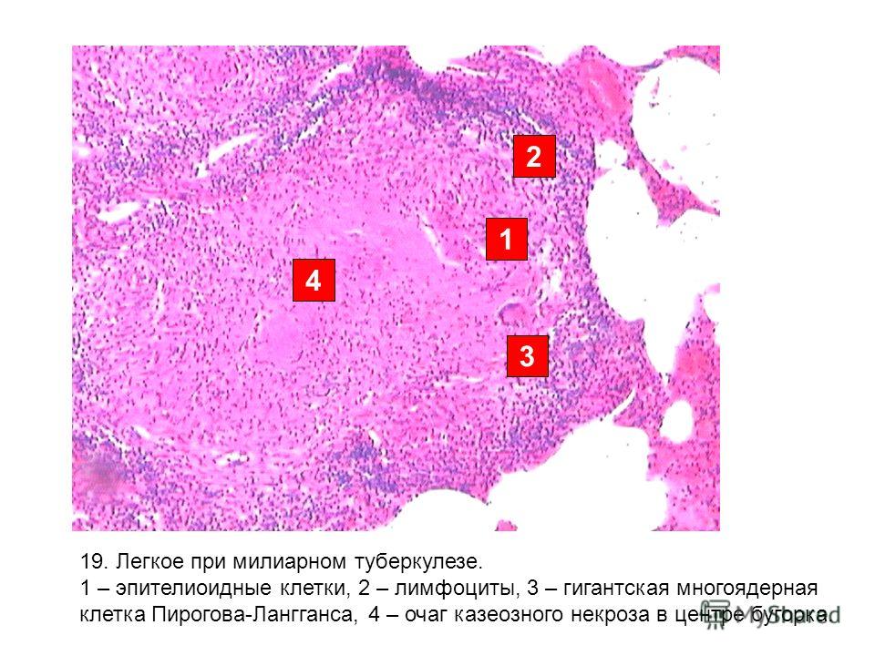 Туберкулезная каверна микропрепарат рисунок