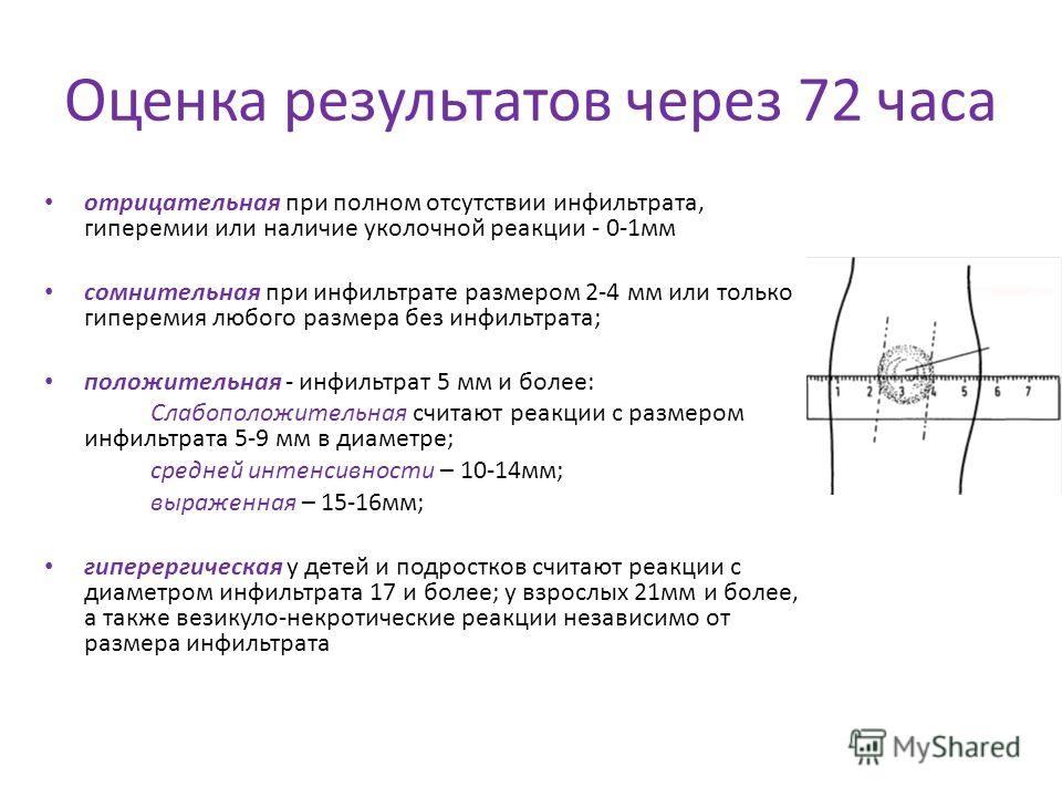 Какая норма диаскинтеста у детей