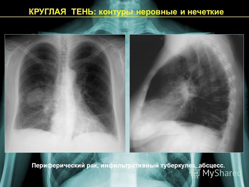 При какой форме рака легкого наблюдается картина быстротечного пневмонита