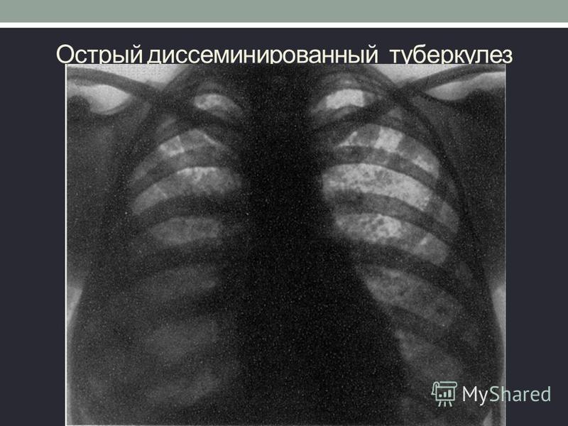 Острый диссеминированный туберкулез. Диссеминированный туберкулез на рентгенограмме. Диссеминированный туберкулёз лёгких рентгенограмма. Острый диссеминированный туберкулез легких рентген. Острый милиарный диссеминированный туберкулез.
