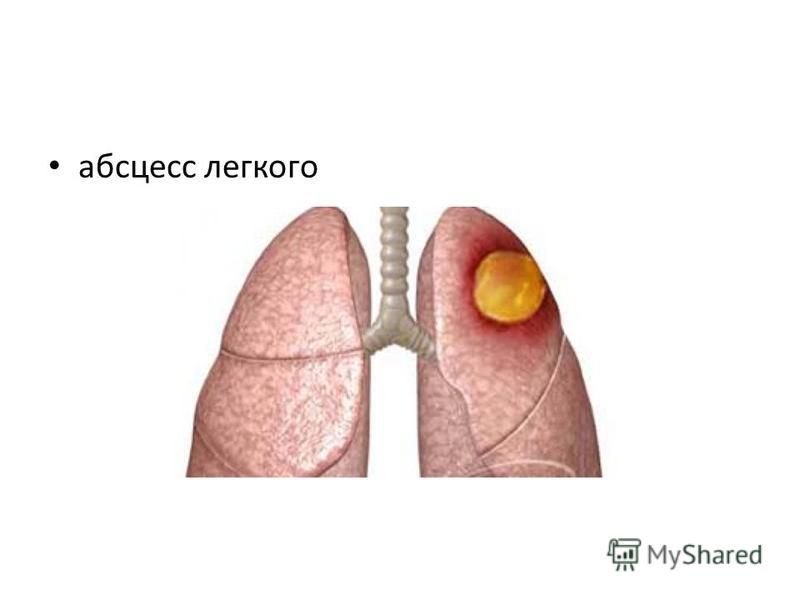 Абсцесс легкого операция. Острый Гнойный абсцесс легкого. Абсцесс легкого картинки. Периферический абсцесс легкого это. Прорыв абсцесса легкого.