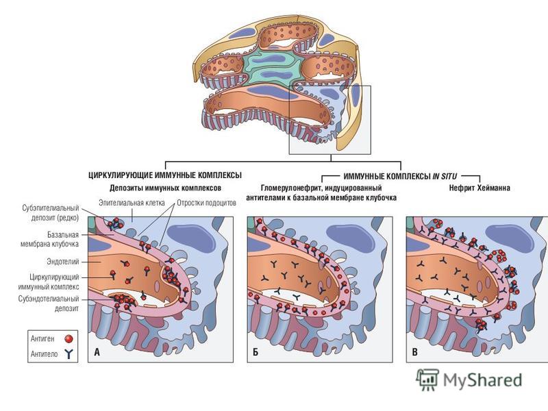 Антитела к базальной мембране. Циркулирующие иммунные комплексы патогенез. Формирование иммунных комплексов. Определение циркулирующих иммунных комплексов.