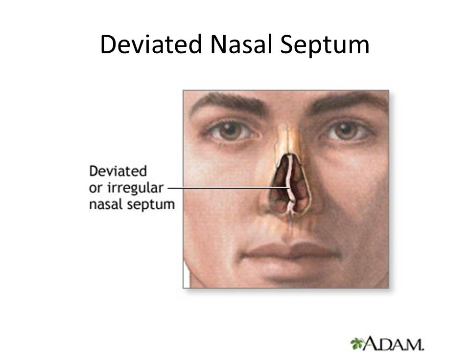 Операция при насморке. Септопластика искривление носовой перегородки. Искривление носовой перегородки врожденная патология. Анатомия искривлённой носовой перегородки. Искривленная перегородка носа.