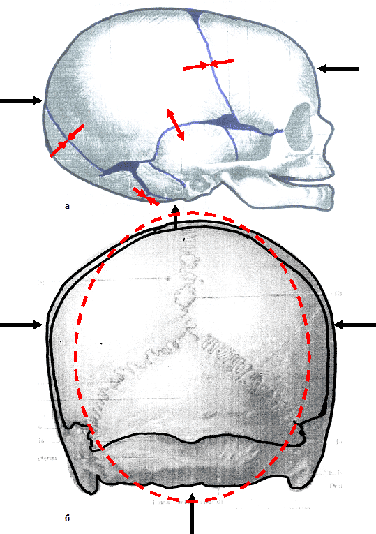 Швы свода черепа. Линейный перелом черепа симптомы. Швы черепа новорожденного рентген. Перелом костей черепа новорожденного.