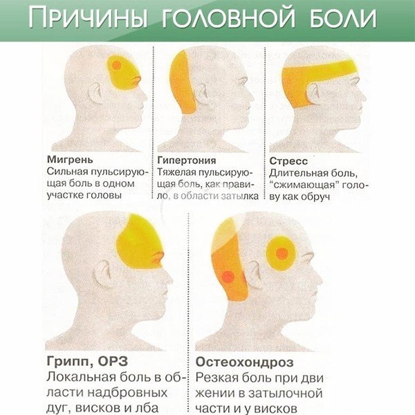 Больно затылок. Схема локализации головной боли. Причины головной боли.