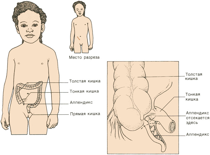Аппендицит расположение схема