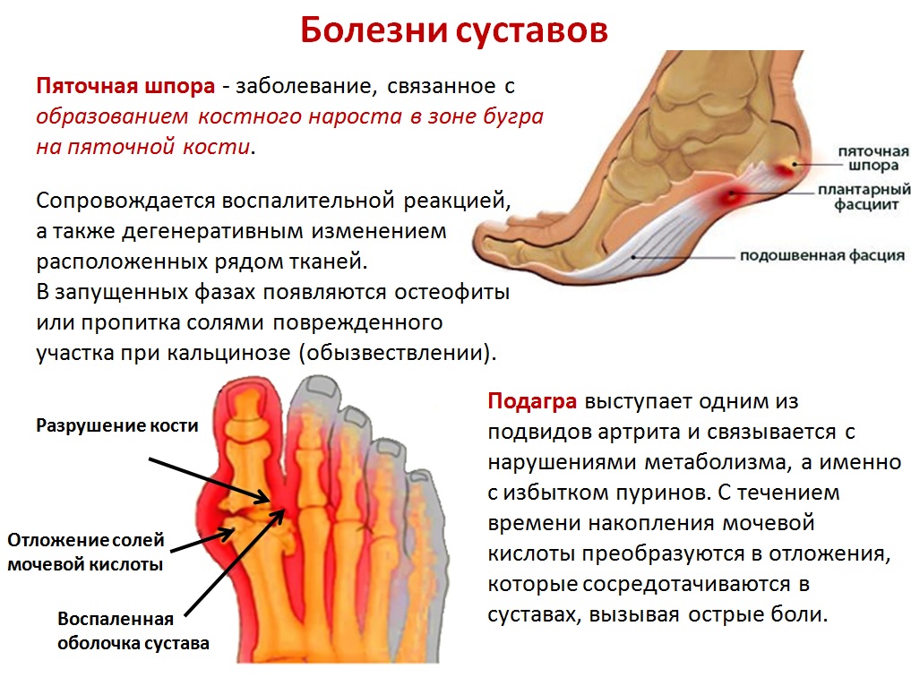 Болит большой палец ноги при ходьбе. Пяточная шпора симптомы.