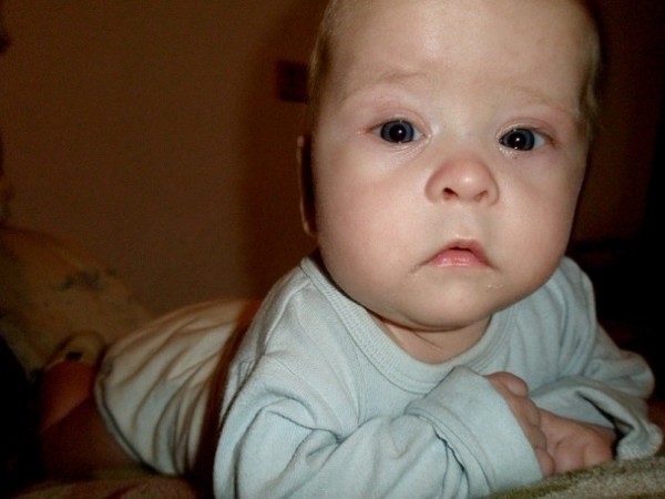 Кривой лоб. Асимметричное лицо у ребенка. Асимметрия лица у младенца. Кривошея асимметрия лица. Асимметрия глаз у новорожденного.