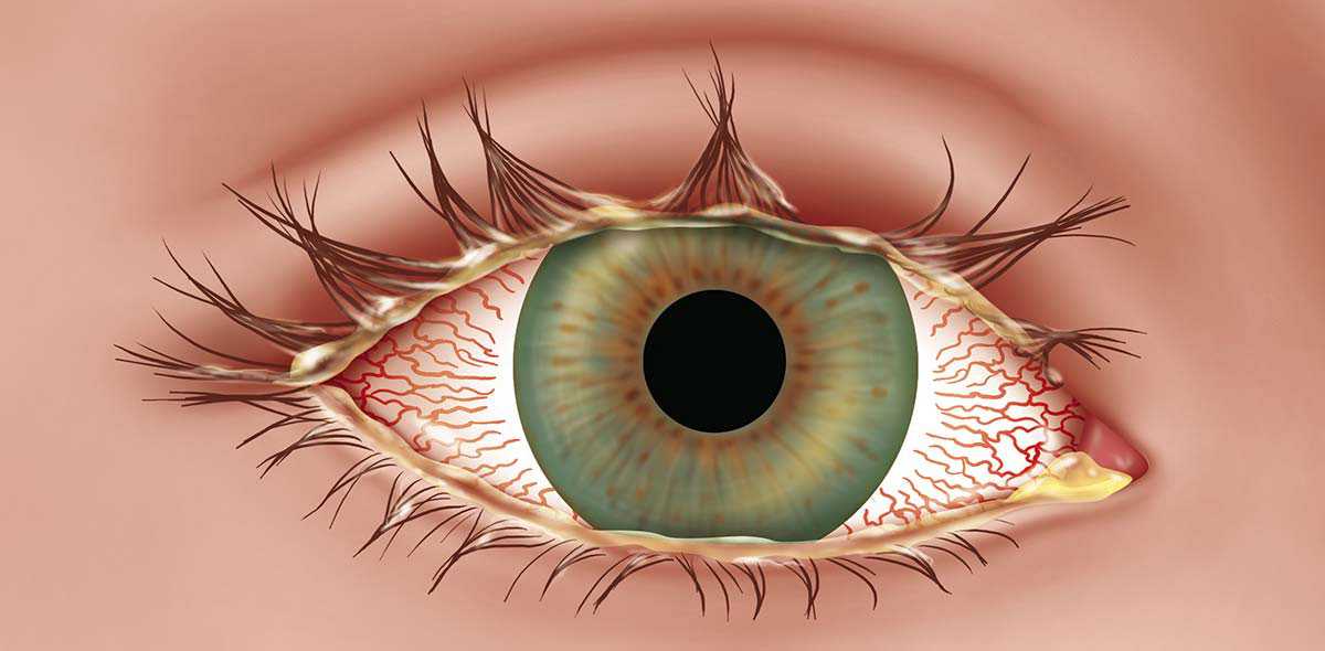Заболеваниями заболеваний глаз появиться. Гонорейный конъюнктивит. Язвенный (стафилококковый) блефарит. Кератит, конъюнктивит, увеит). Хламидийный конъюнктивит-кератит.