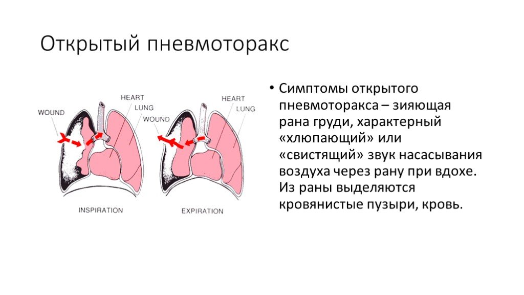 Клапанный пневмоторакс презентация