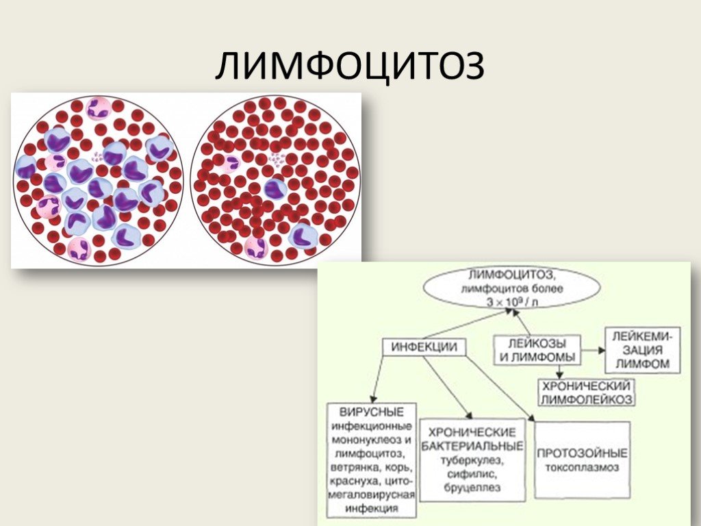 Абсолютный лейкоцитоз. Механизм развития лимфоцитоза. Лимфоцитоз у взрослых в крови. Лейкоцитоз при лимфоцитозе. Лимфоцитоз картина крови.