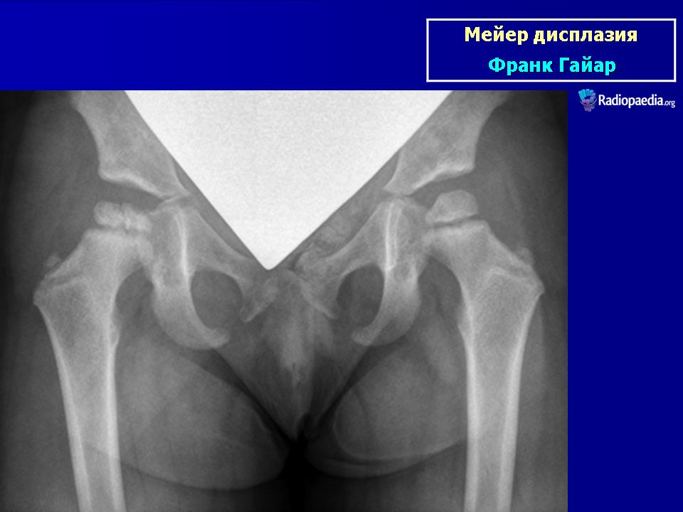 Эпифизарная дисплазия голеней рентген. Гемимелическая эпифизарная дисплазия. Пателлофеморальная дисплазия. Эпифизарная дисплазия тазобедренного сустава рентген. Дисплазия Майера рентген.