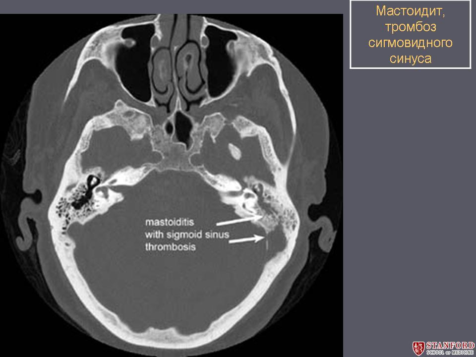 Мастоидит мрт картина