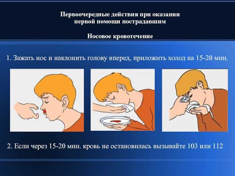 На каком из рисунков наиболее правильно показан метод остановки кровотечения из носа