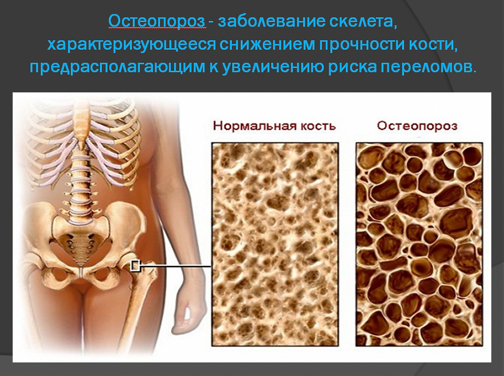 В костях и т д. Остеопороз. Остеопороз кости. Заболевание костей остеопороз. Костная ткань остеопороз.