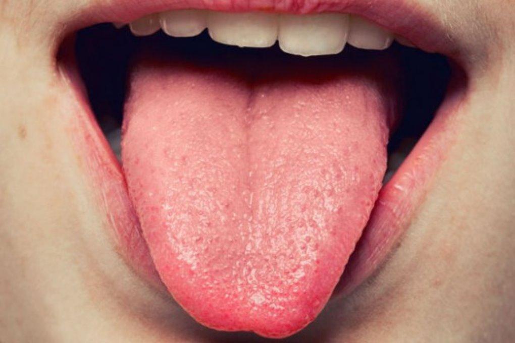 Como limpiar la lengua blanca