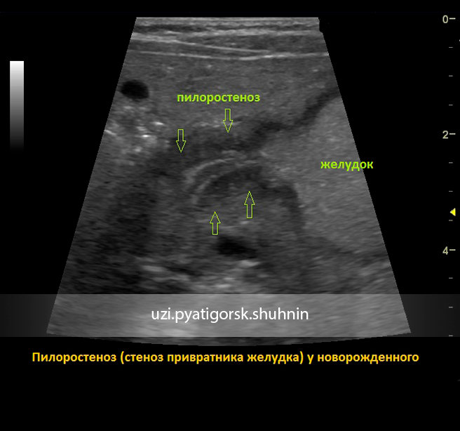 Новорожденный ребенок узи. Пилородуоденальный стеноз УЗИ. Врожденный пилоростеноз УЗИ. Стеноз привратника на УЗИ.