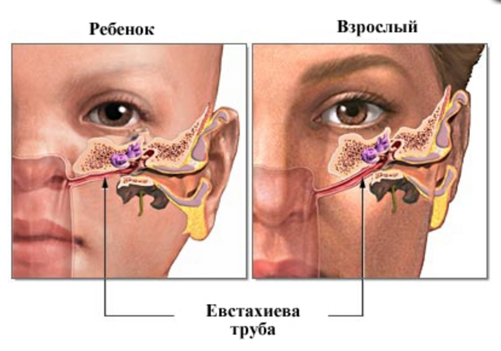 Средний отит картинка