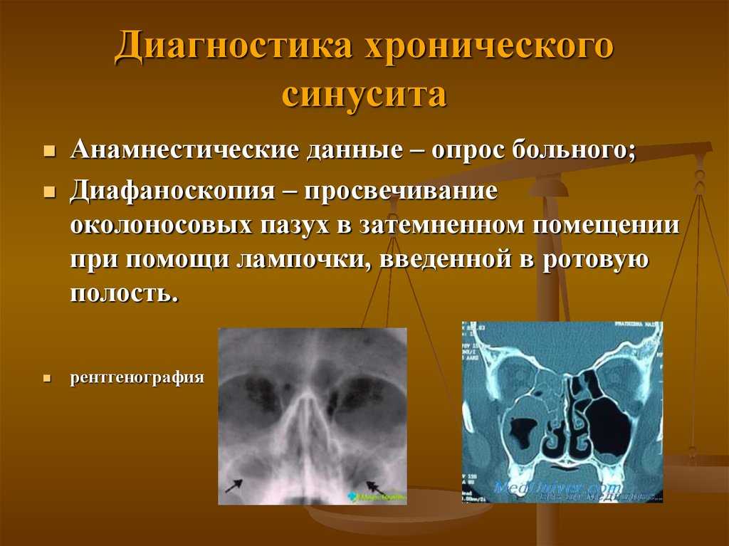 Презентация гайморит лечение