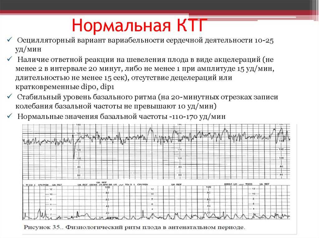 Ктг рисует схватки