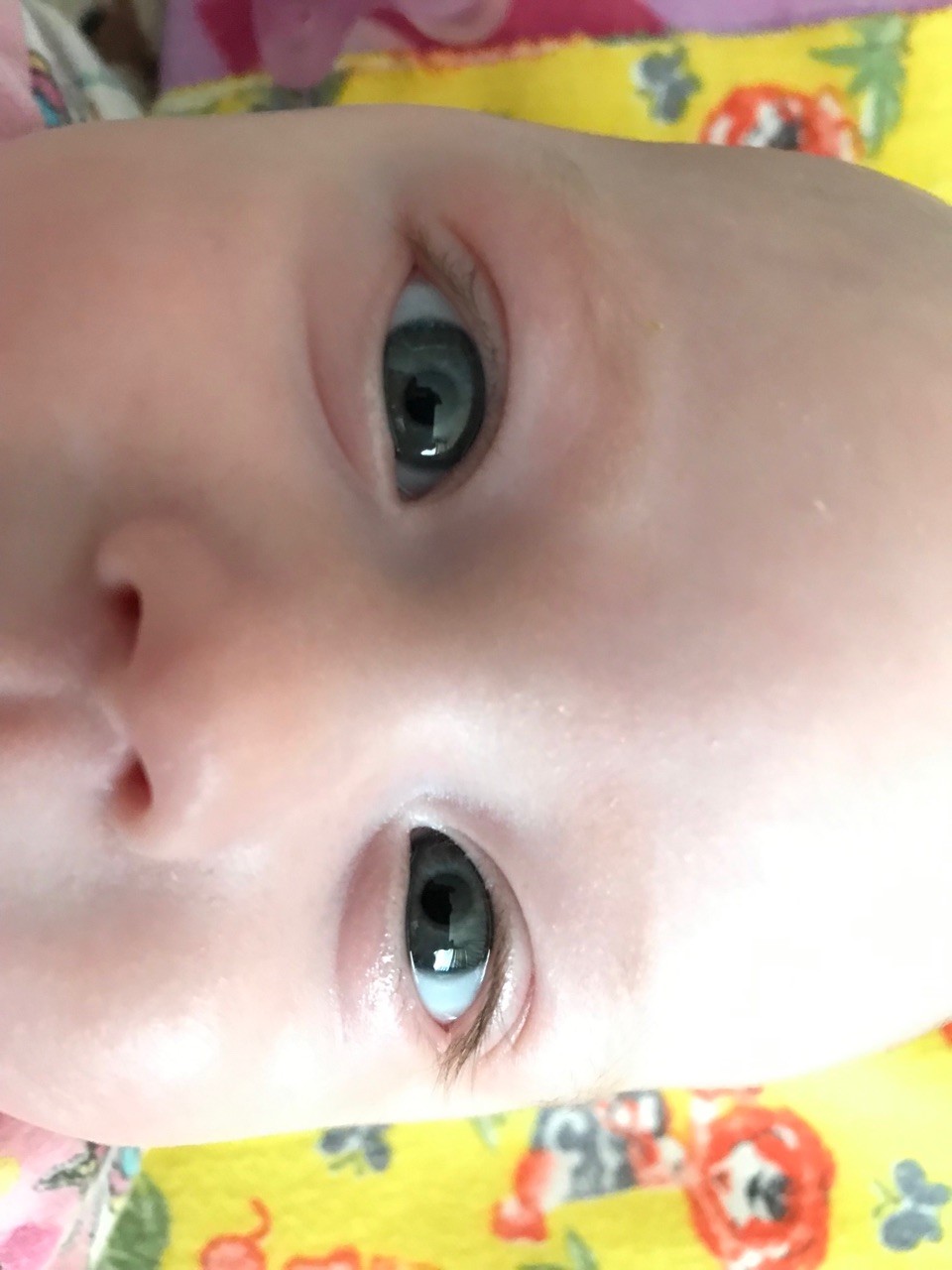 Ребенок температура слезятся глаза. Конъюнктивит и дакриоцистит новорожденных. Конъюнктивит у грудничка. Глаза месячного ребенка. Слезится глаз у грудничка.