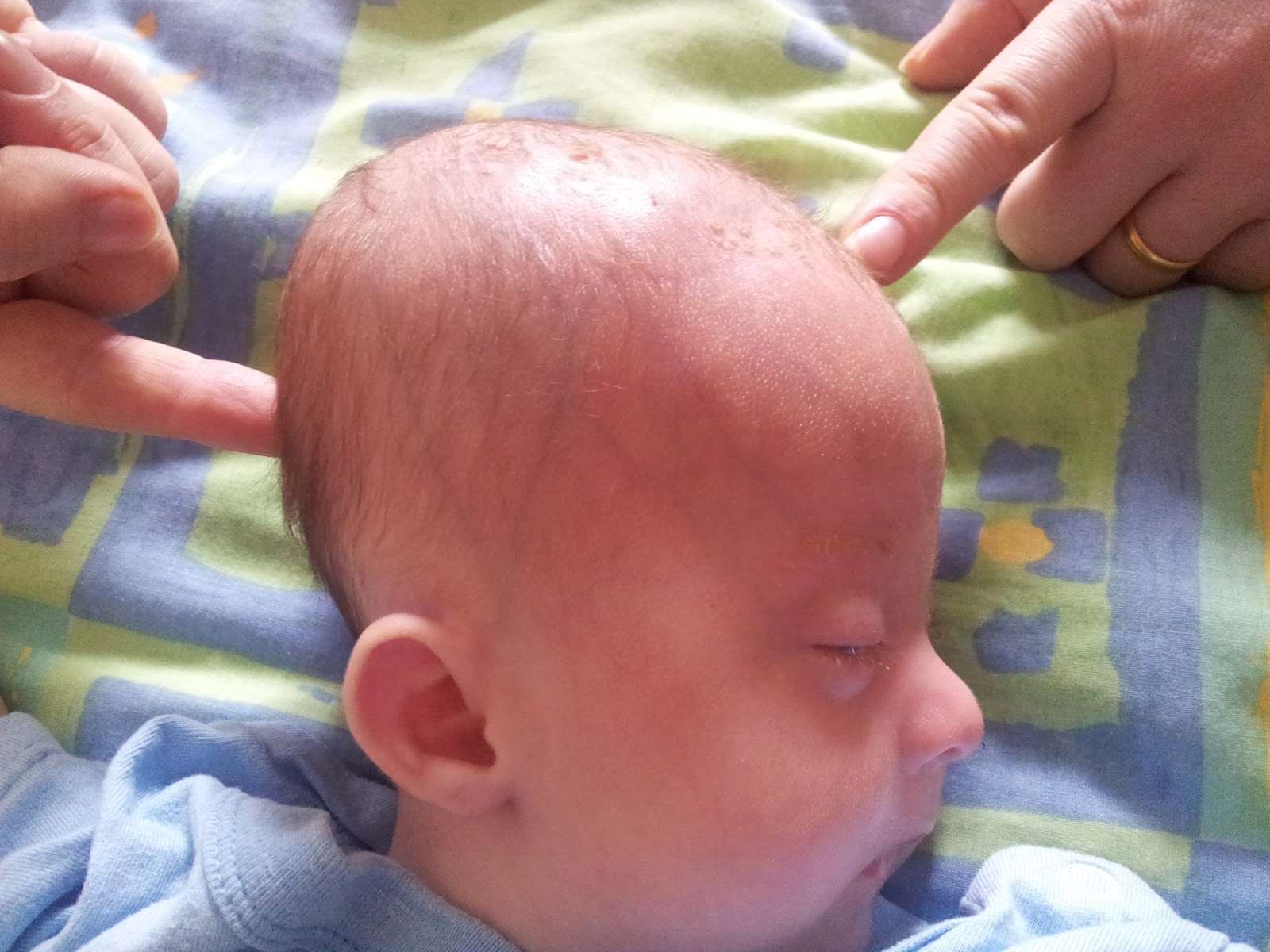 Родничок 1 год. Гидроцефалия кефалогематома. Кефалогематома кривошея. Гидроцефальная форма головы у ребенка. Родничок на темени у новорожденного.