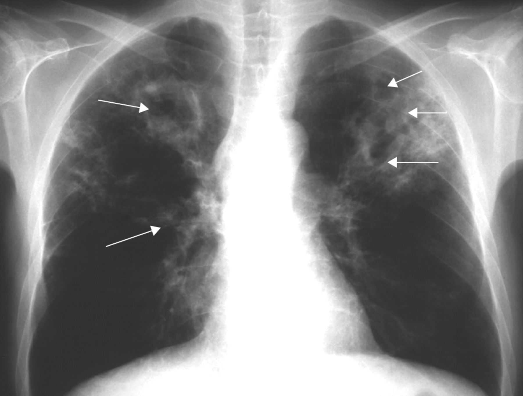Туберкулез легкого рентгенограмма