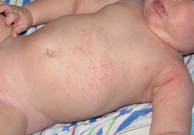 У малыша аллергия на кожу